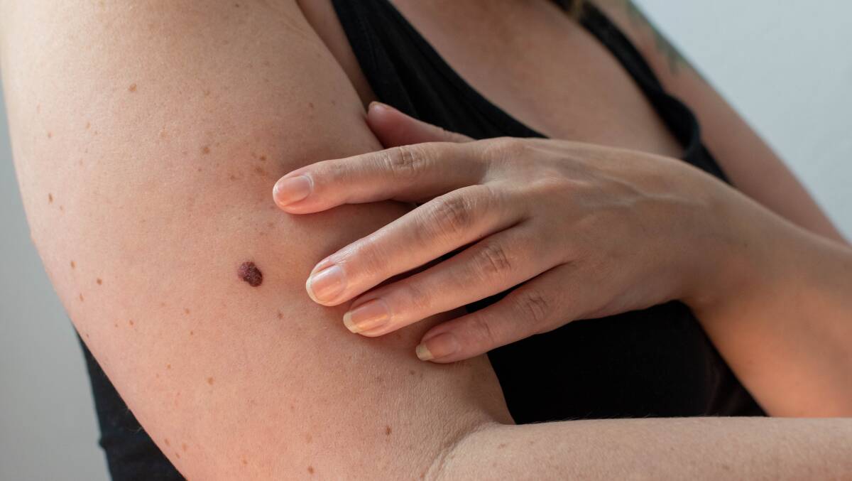 More than 90 per cent of melanomas can be treated if they're picked up early. Picture from Shutterstock