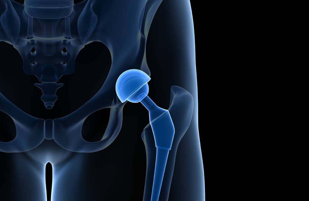 File image of a hip x-ray. Picture from Shutterstock