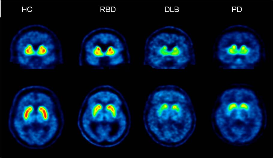 PET scan brain images left to right - HC (healthy control), RBD (person with REM behavioural disorder), DLB (person with dementia with Lewey bodies), and PD (person with Parkinsons disease). Picture by Austin Health 